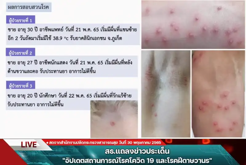 ลักษณะอาการ ยังไม่พบผู้ป่วยฝีดาษวานรในไทย ผลตรวจฝรั่ง 3 รายยืนยันเป็นเริม