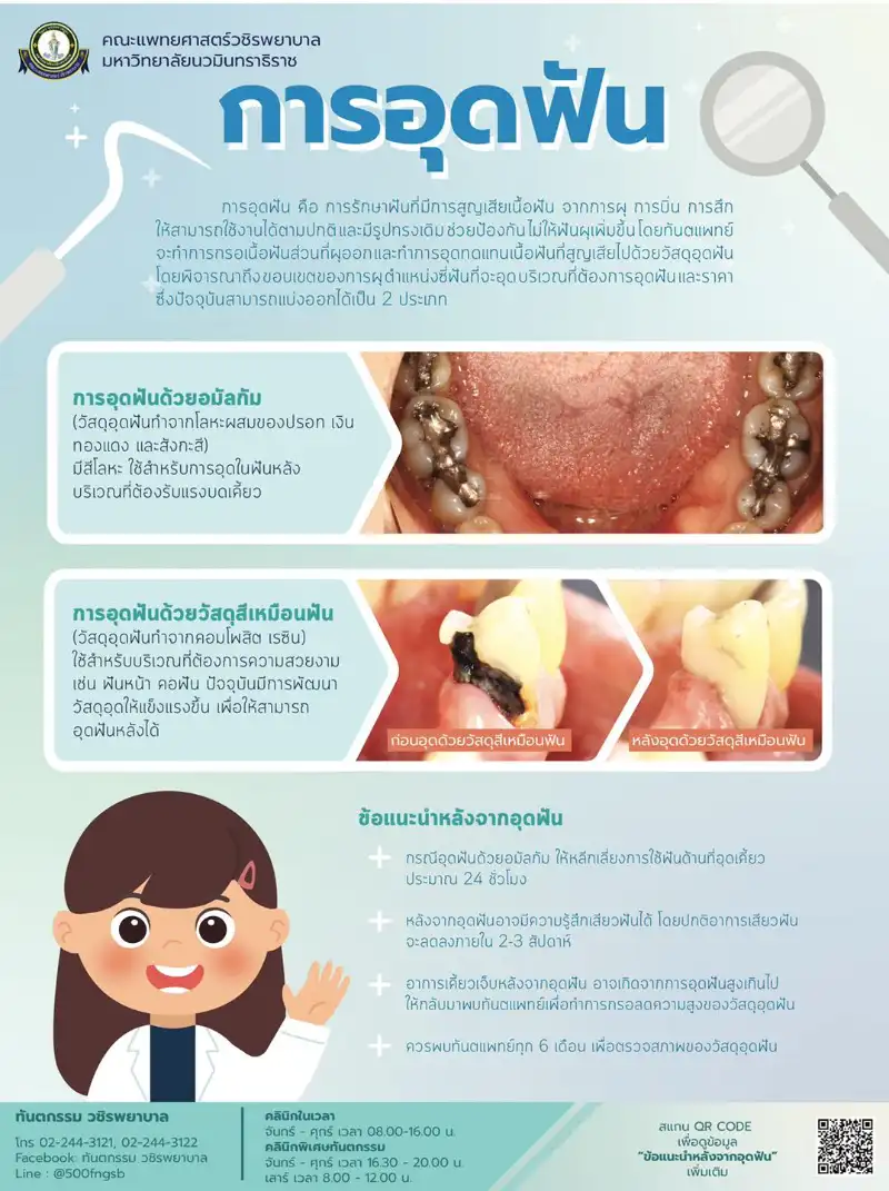 การอุดฟันด้วยอมัลกัม และวัสดุสีเหมือนฟัน ต่างกันอย่างไรนะ? รอบรู้เรื่องทันตกรรม ปากและฟัน (ทันตกรรม วชิรพยาบาล)
