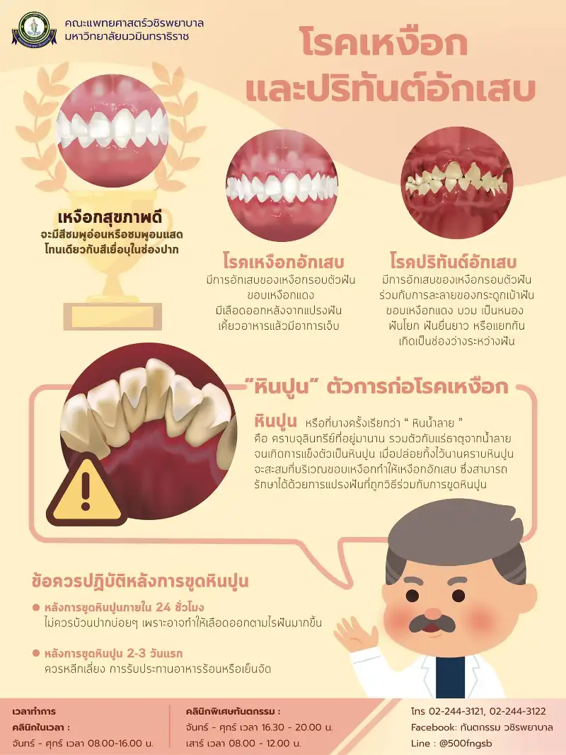 โรคเหงือกและปริทันต์อักเสบคืออะไร จัดการอย่างไร รอบรู้เรื่องทันตกรรม ปากและฟัน (ทันตกรรม วชิรพยาบาล)