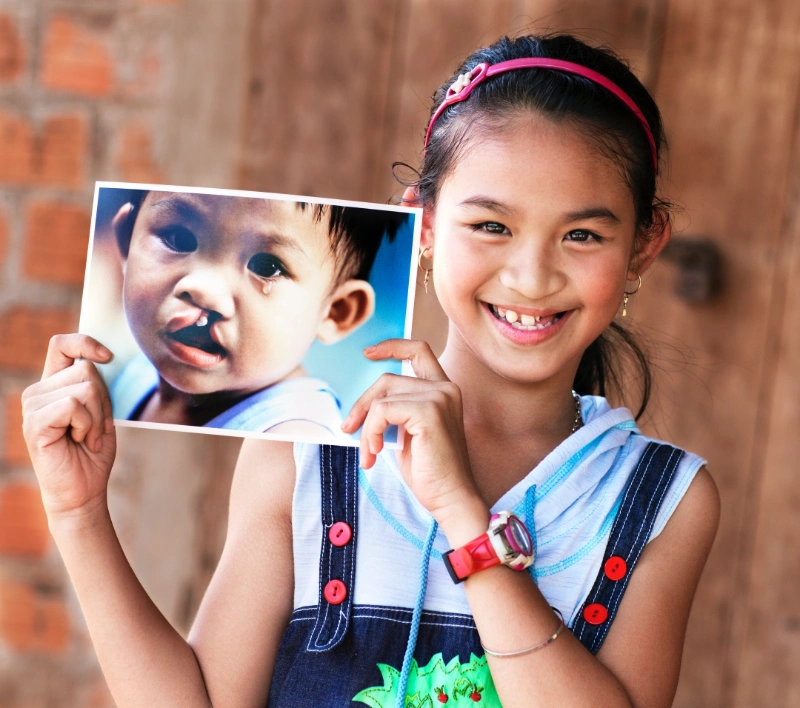  มูลนิธิสร้างรอยยิ้มและฟูจิฟิล์ม เดินหน้าช่วยผู้ป่วยปากแหว่งเพดานโหว่ ผ่านโครงการ 100 รอยยิ้ม