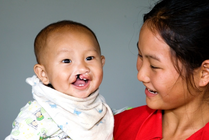  มูลนิธิสร้างรอยยิ้มและฟูจิฟิล์ม เดินหน้าช่วยผู้ป่วยปากแหว่งเพดานโหว่ ผ่านโครงการ 100 รอยยิ้ม