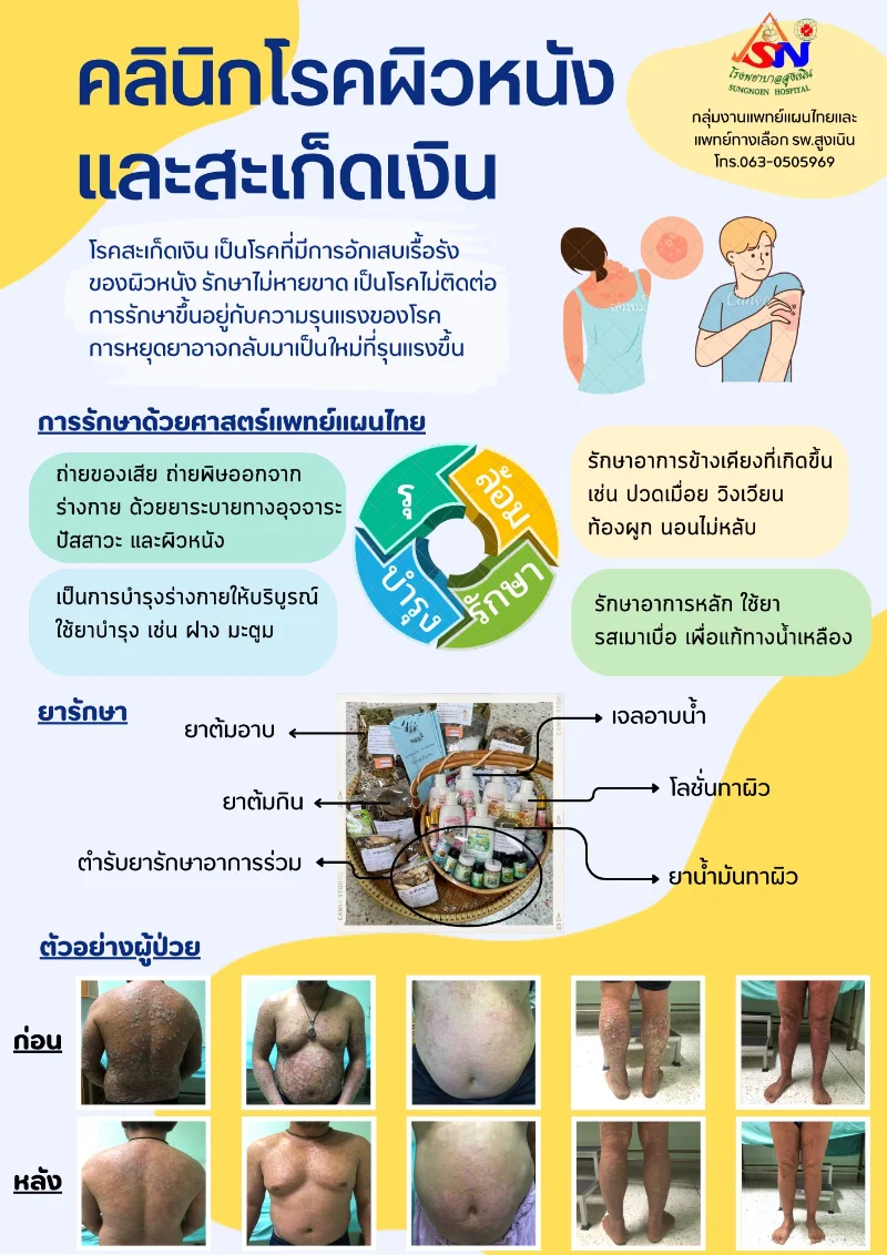 ประชาสัมพันธ์ คลินิกโรคผิวหนังและสะเก็ดเงิน คลินิกแพทย์แผนไทย รพ.สูงเนิน โรงพยาบาลสูงเนิน