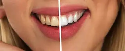 น่ารู้เรื่องการฟอกสีฟัน HealthServ.net