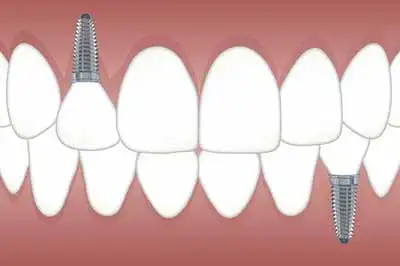 รู้จักรากฟันเทียม ประโยชน์และผู้ที่ควรเข้ารับการทำรากฟันเทียม HealthServ.net