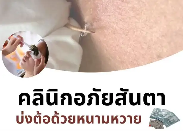 บ่งต้อด้วยหนามหวาย โรงพยาบาลการแพทย์แผนไทย อุดรธานี HealthServ.net
