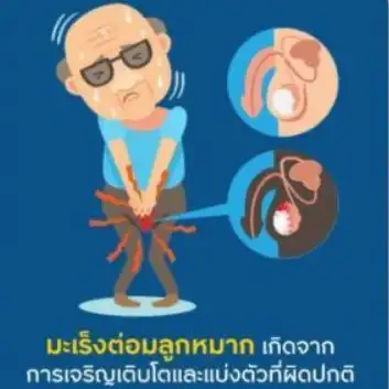 ชายไทยควรรู้ ภัยเงียบของมะเร็งต่อมลูกหมาก ป่วยเพิ่มวันละ 10 คน HealthServ.net