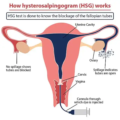 การฉีดสีตรวจท่อนำไข่ ขั้นตอนและการเตรียมตัว Hysterosalpingography (HSG) HealthServ.net