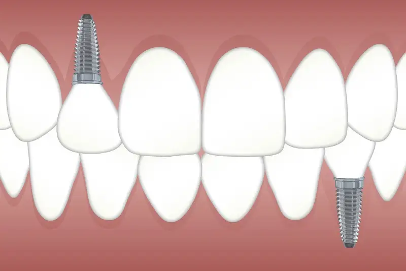 รู้จักรากฟันเทียม ประโยชน์และผู้ที่ควรเข้ารับการทำรากฟันเทียม HealthServ
