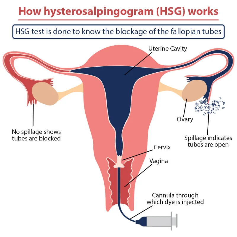 การฉีดสีตรวจท่อนำไข่ ขั้นตอนและการเตรียมตัว Hysterosalpingography (HSG) HealthServ