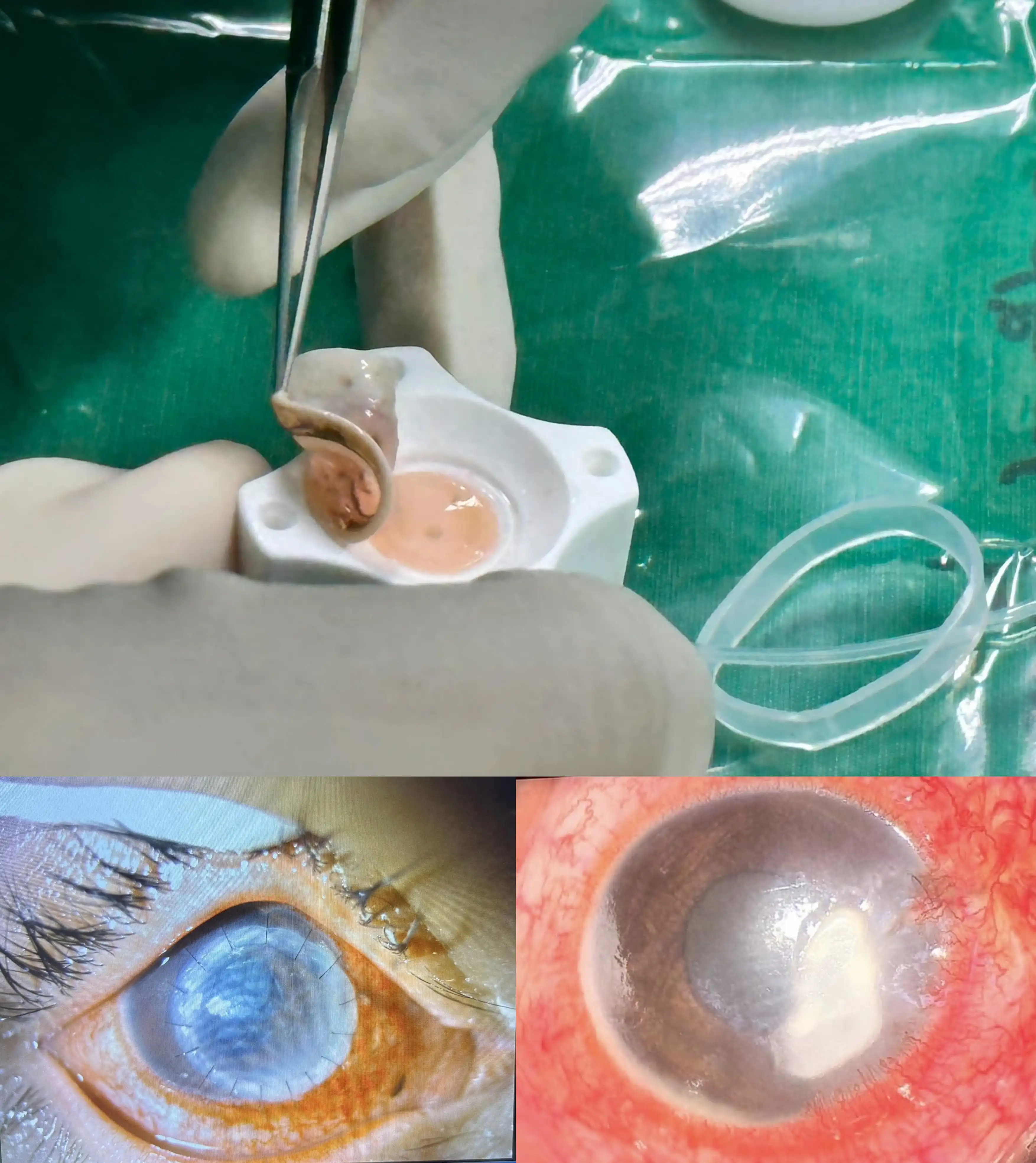 รพ.กระบี่ ผ่าตัดเปลี่ยนกระจกตาสำเร็จเป็นรายที่ 2 ของจังหวัดกระบี่ HealthServ