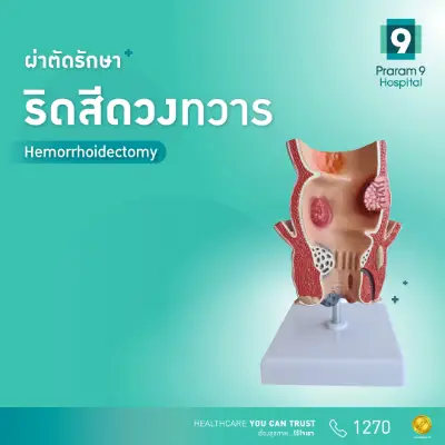 ริดสีดวงทวาร โรคฮิตที่หลายคนหวาดผวา HealthServ