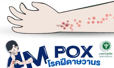 [Infographic] Mpox โรคฝีดาษวานร (monkeypox) รู้ไว้ ป้องกันได้ Thumb HealthServ.net